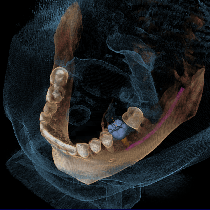 Все, что вам нужно знать о 3D-томографии челюсти: технология, преимущества и применение