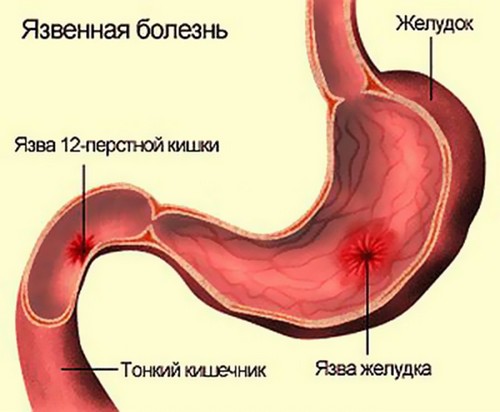Язва желудка и кишечника фото thumbnail