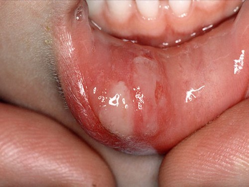Бактериальный стоматит симптомы и лечение thumbnail