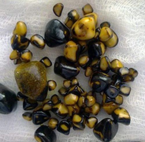 Камни из поджелудочной железы фото камней thumbnail