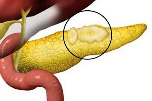 Что такое липоматоз поджелудочной железы