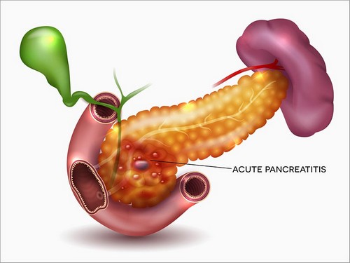Лечение больных с диагнозом деструктивный панкреатит осуществляется только в условиях стационара