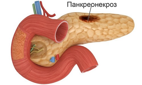 Что такое панкреонекроз поджелудочной железы