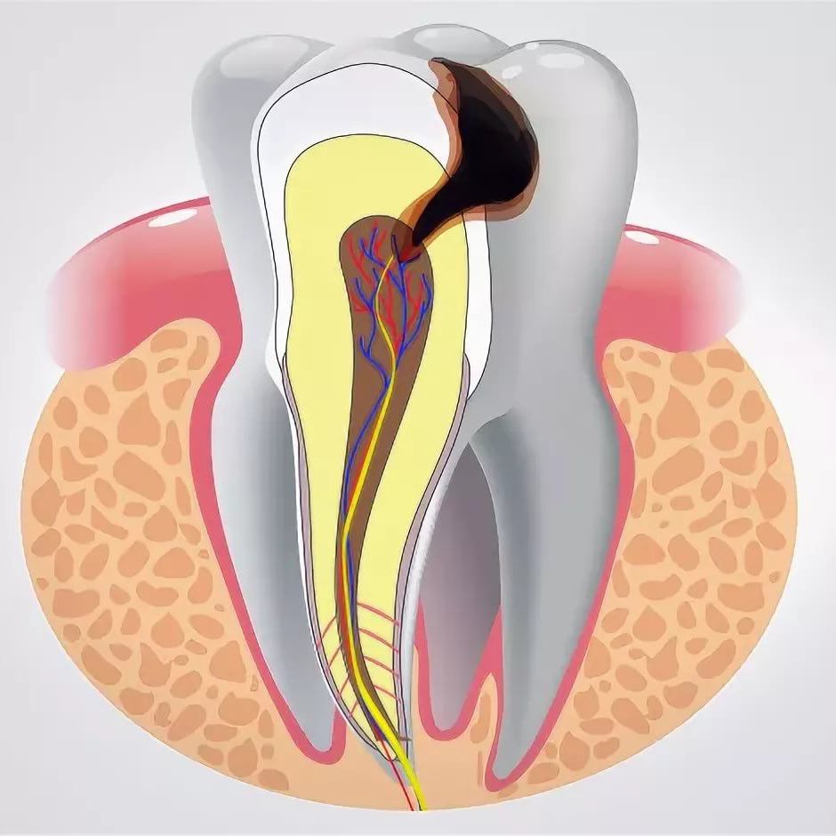 Лечение пульпита: как избавиться от боли в зубах